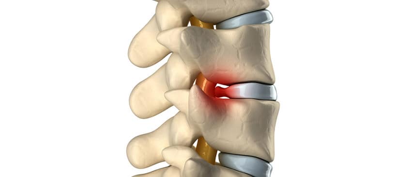 6 Tips for Relieving Pain From Herniated Discs